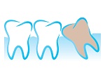 Wisdom Teeth in Toronto